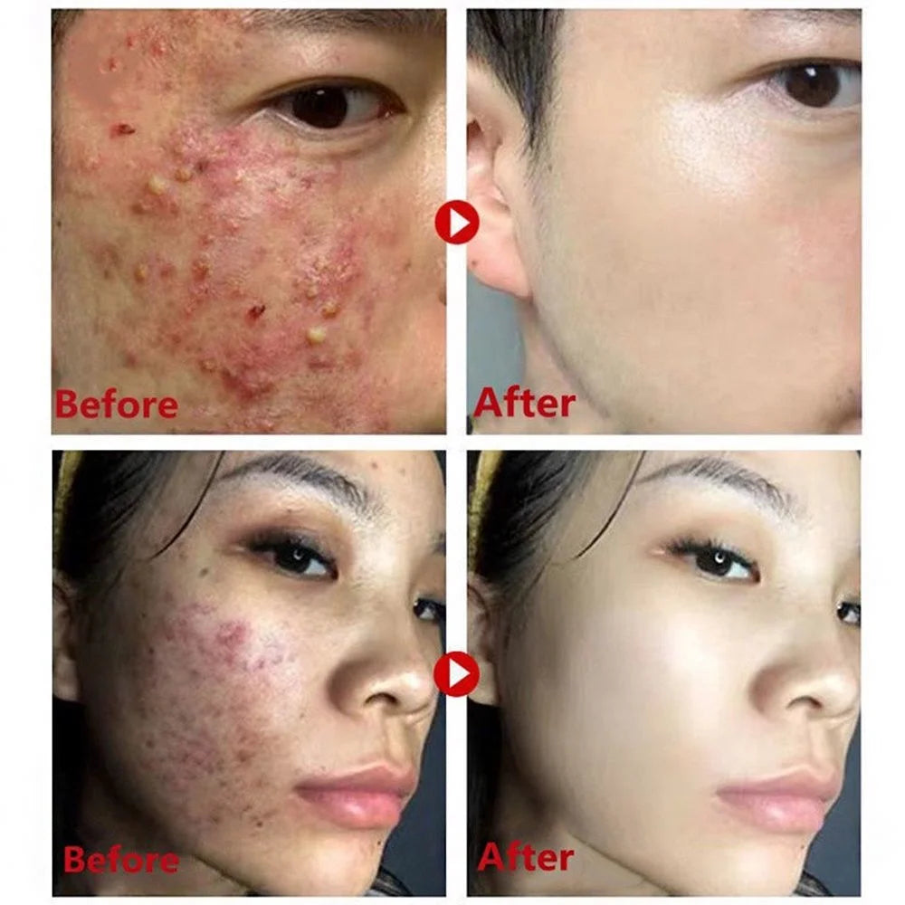 Original Green Tea Deep Remove Blackheads Acne Mud Mask Stick Shrink Pores Dispel Acne Cream Treat Pimple Korean Clean Skin Care
