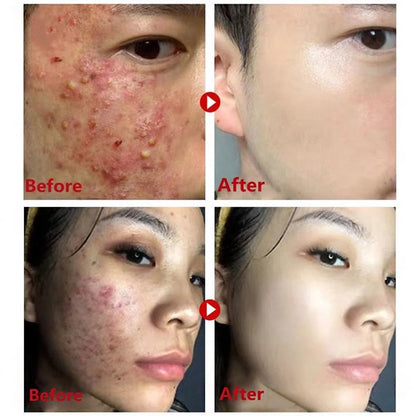 Original Green Tea Deep Remove Blackheads Acne Mud Mask Stick Shrink Pores Dispel Acne Cream Treat Pimple Korean Clean Skin Care