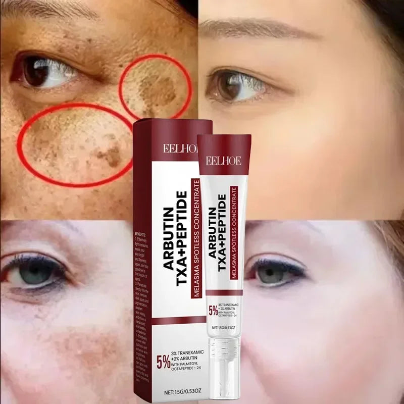 Fast Eliminates Melanin Pigmentation Melasma Dark Spots Skin Care New 2025