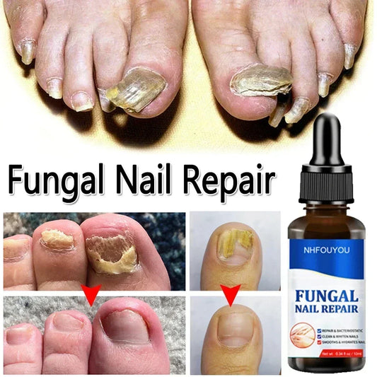 Nail Fungals Renewal Nail Repair Liquid for Discolored Thickened Crumbled Nails Nail Fungals for Discolored Broken Cracked