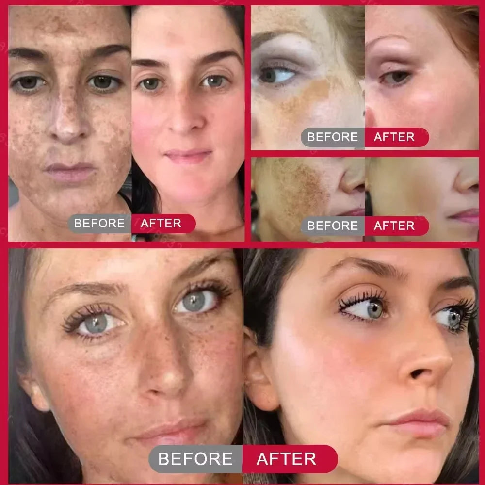 Niacinamide Whitening Freckles Serum Removal Melasma Dark Spots Lighten Melanin Pigmentation Brightening Anti-Aging Skin Care