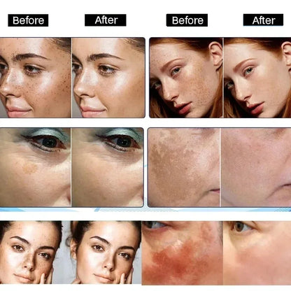 Dark Spot Remove Serum Fade Anti-aging Bright Freckle