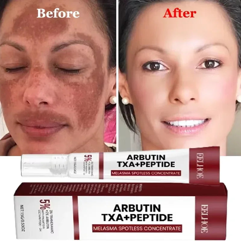 Fast Eliminates Melanin Pigmentation Melasma Dark Spots Skin Care New 2025