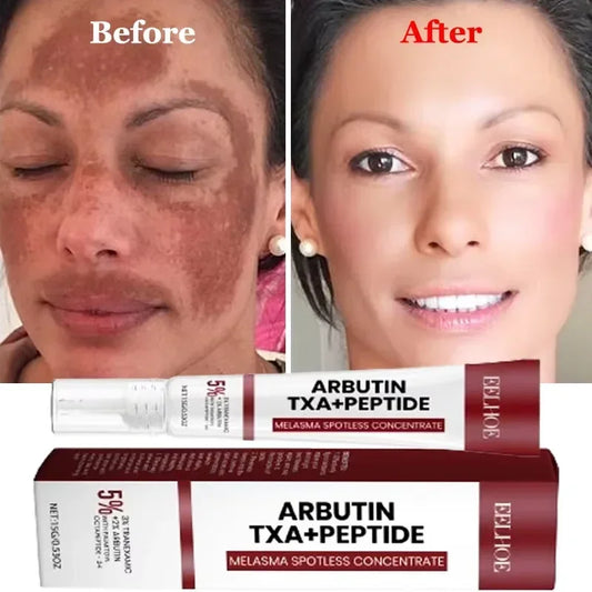 Fast Eliminates Melanin Pigmentation Melasma Dark Spots Skin Care New 2025