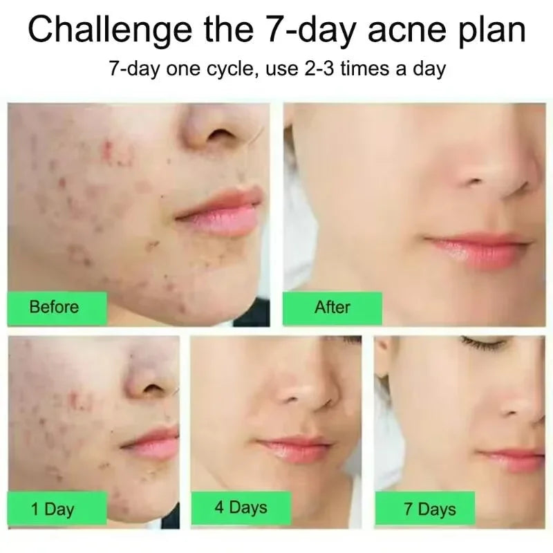 Acne Treatment Face Cream Repair Pimple Spots Deep Cleaning Oil