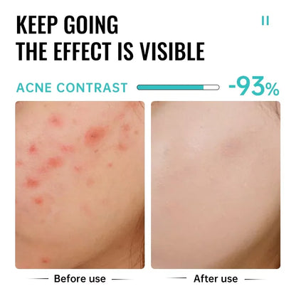 Acne Treatment Face Cream Repair Pimple Spots Deep Cleaning Oil