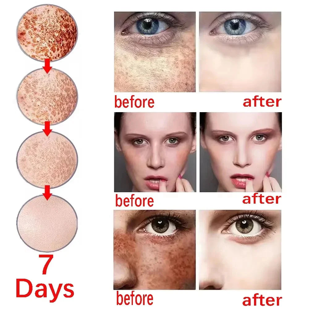 Niacinamide Whitening Freckles Serum Removal Melasma Dark Spots Lighten Melanin Pigmentation Brightening Anti-Aging Skin Care