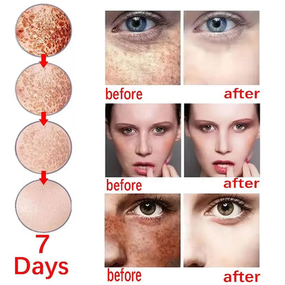 Niacinamide Whitening Freckles Serum Removal Melasma Dark Spots Lighten Melanin Pigmentation Brightening Anti-Aging Skin Care