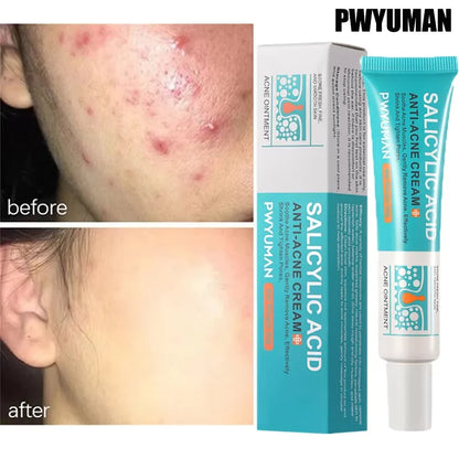 Acne Treatment Face Cream Repair Pimple Spots Deep Cleaning Oil