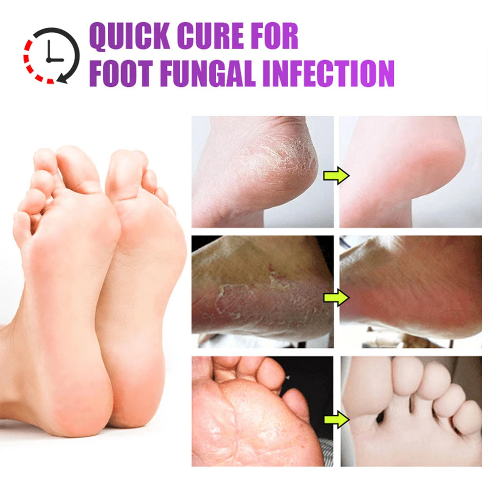 Anti-Foot Fungus Ointment Deodorant Care Products Foot Deodorant Creams Antiseptic and Antiperspirant Foot Skin Topical Cream