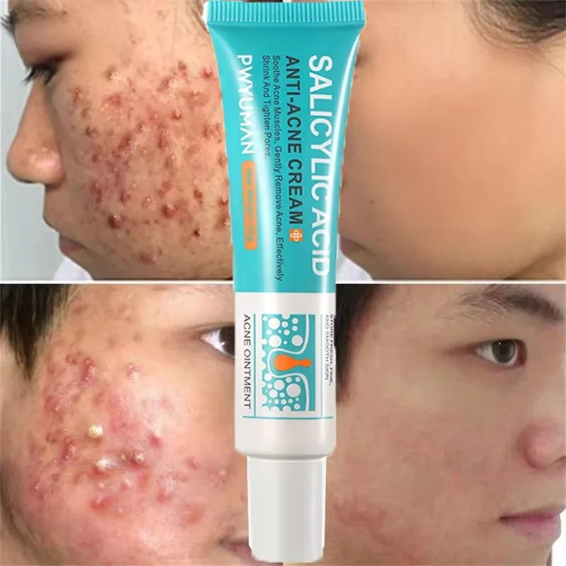 Acne Treatment Face Cream Repair Pimple Spots Deep Cleaning Oil